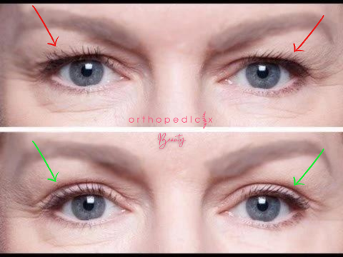 מדבקות להרמת עפעפיים